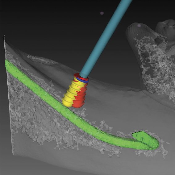 Screw-Free Fixation System